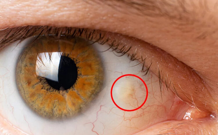 Olho Vermelho, dos Sintomas ao Diagnóstico e Tratamento