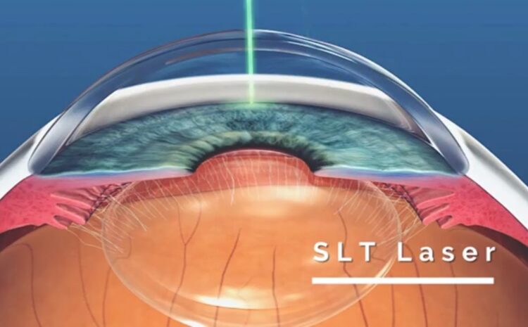  Trabeculoplastia pode tratar casos iniciais de glaucoma