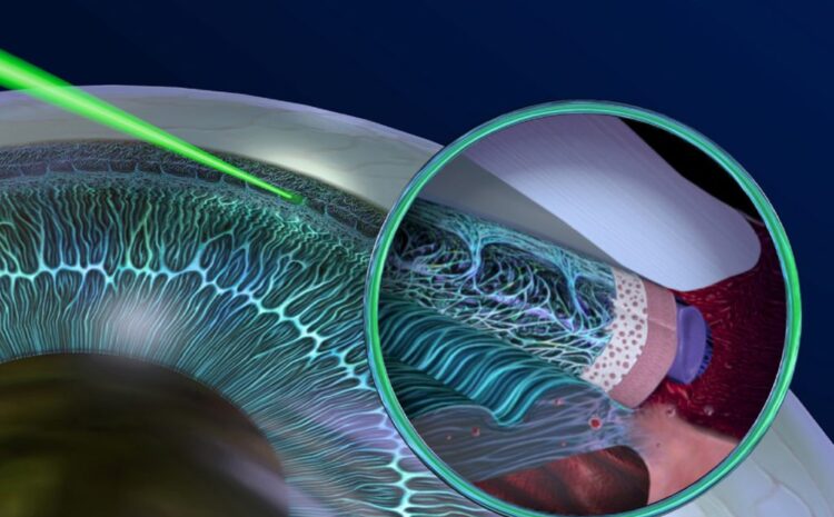  Cirurgia de glaucoma – Quais as indicações