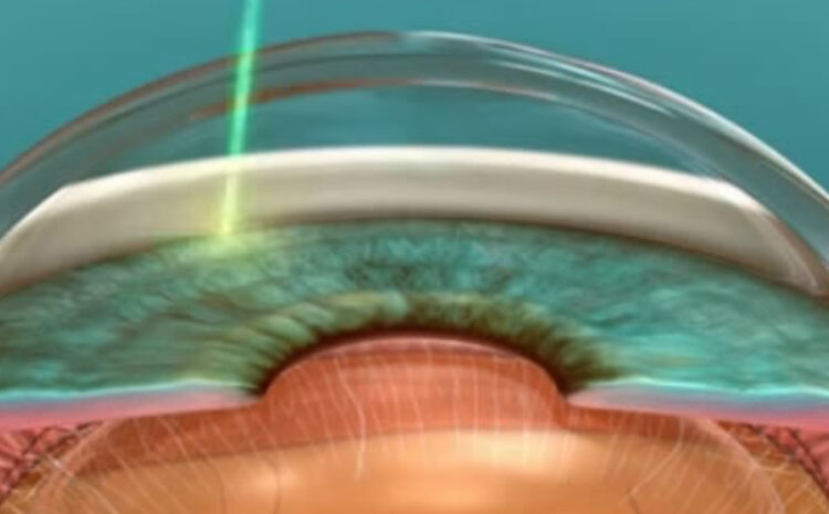  Trabeculoplastia Seletiva a Laser para tratar glaucoma – Como funciona