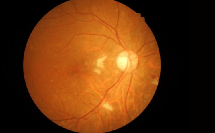  Escavação do nervo óptico e relação com o glaucoma